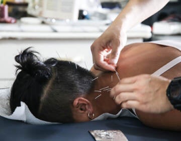 Acupuncturist Toto Cheng performs acupuncture on an athlete. (Lin Tin Nok/WHYY)