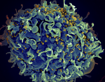 This electron microscope image made available by the U.S. National Institutes of Health shows a human T cell, in blue, under attack by HIV, in yellow, the virus that causes AIDS.