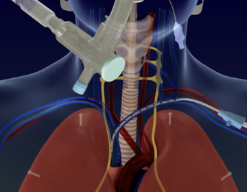 Through a catheter (on the right), the Lungpacer sends small electrical signals to the nerves to coax the diaphragm into action while the patient is on the ventilator. (Screenshot via Lungpacer Medical Inc.)